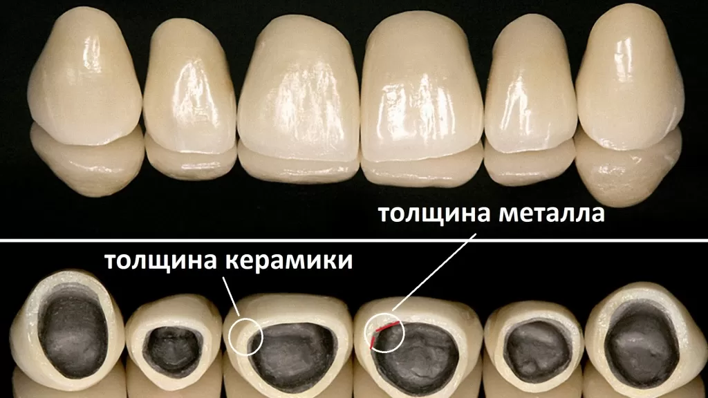 При самом “неэстетическом” , но самом щадящем для пациента раскладе, толщина зубной коронки будет 1 мм